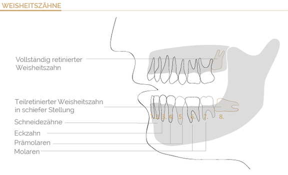 Nach der weisheitszahn op