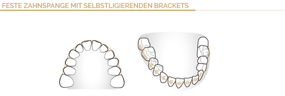 Zahnspangenarten, Zahnarzt Böblingen, Dr. Wagner