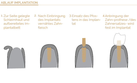 Ablauf Implantologie, Zahnarzt Böblingen, Dr. Wagner