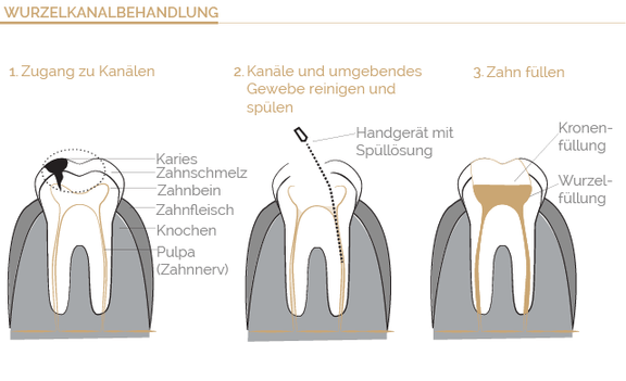 Wurzelkanalbehandlung, Zahnarzt Böblingen, Dr. Wagner