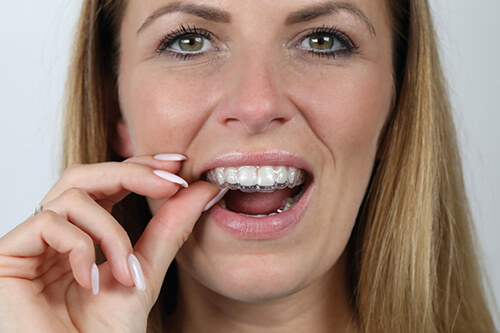 Aligner einsetzen - Zahnarzt Böblingen