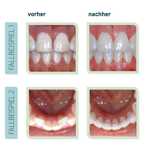unsichtbare Zahnspange vorher nachher - Zahnarzt Böblingen