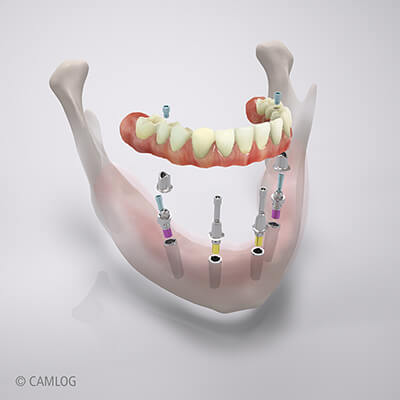 Camlog Zahnimplantat Aufbau - Zahnarzt Böblingen