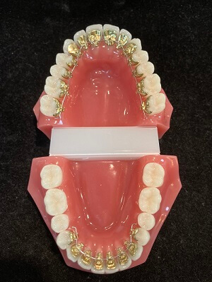 Linguale Zahnspange mit Incognito-Methode - Kieferorthopäde Böblingen